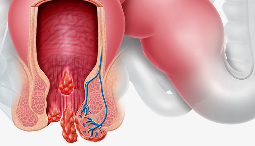 HEMORROIDA